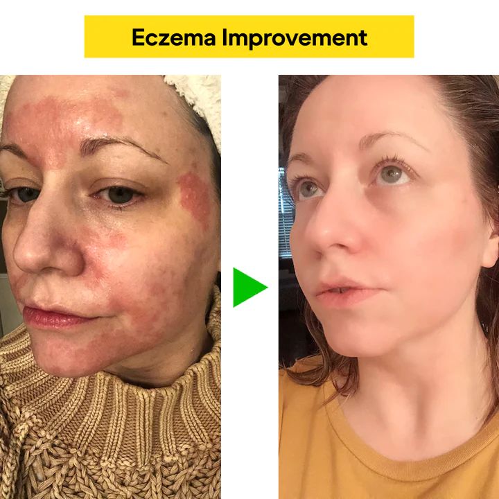 East Asia Eczema & Psoriasis Natural Herbal Cream